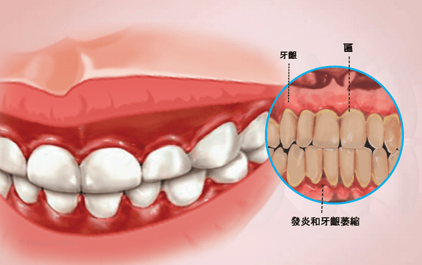 牙齦發炎