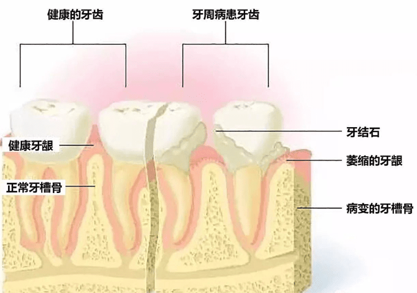 牙周病