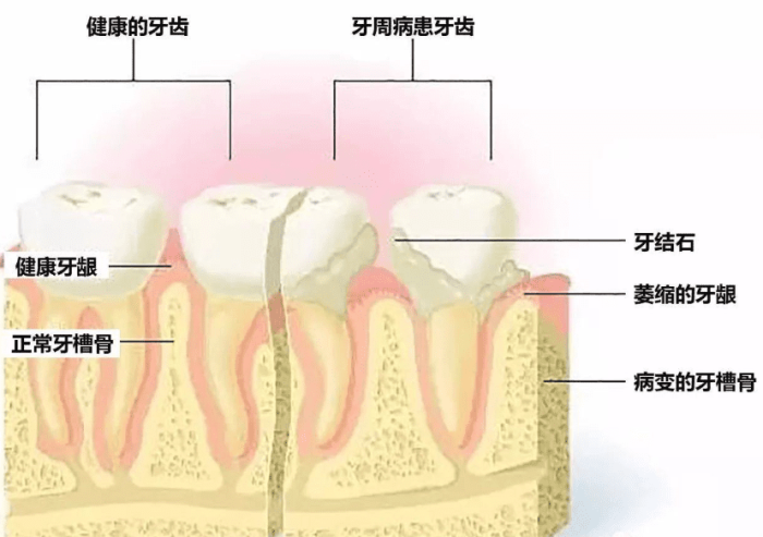 牙周病 牙周病