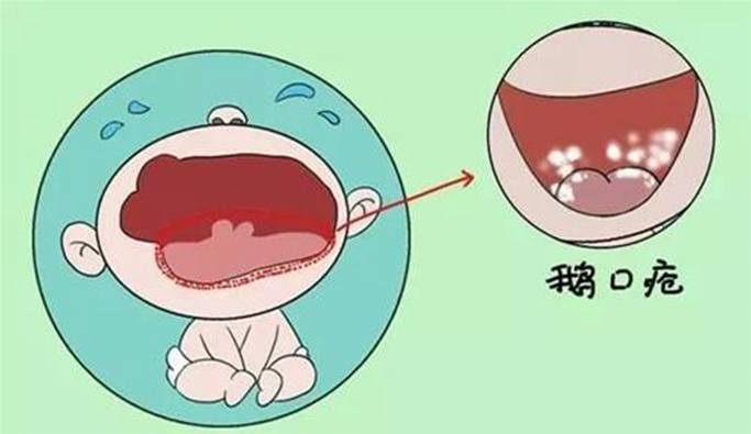 口腔念珠菌