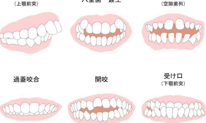 正常咬合