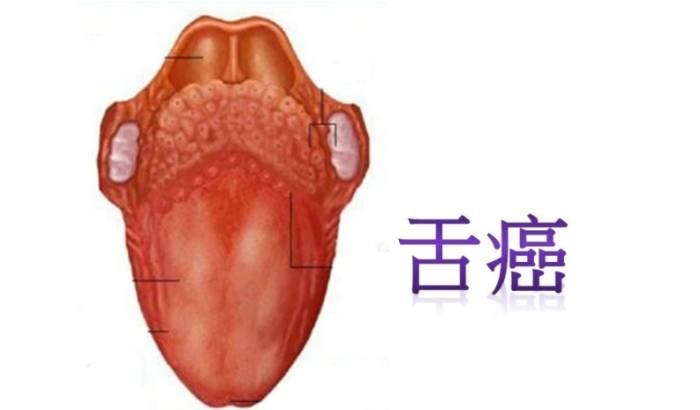 舌癌