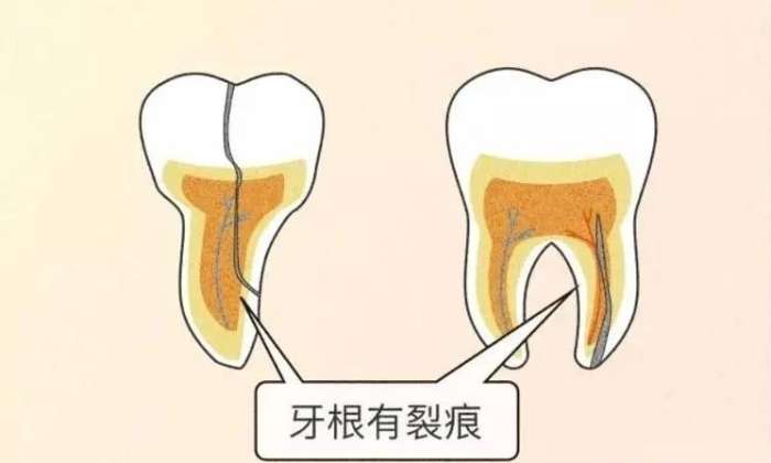 牙隱裂自愈