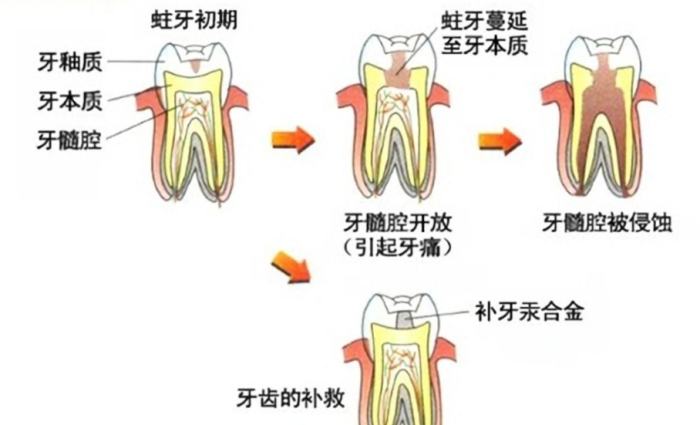 牙髓炎怎麼判斷