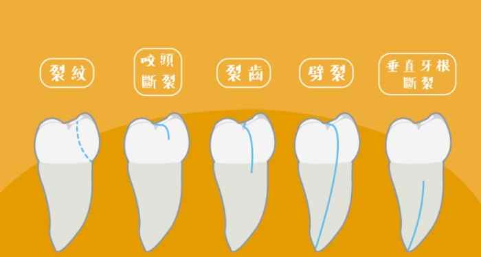 牙齒裂開原因