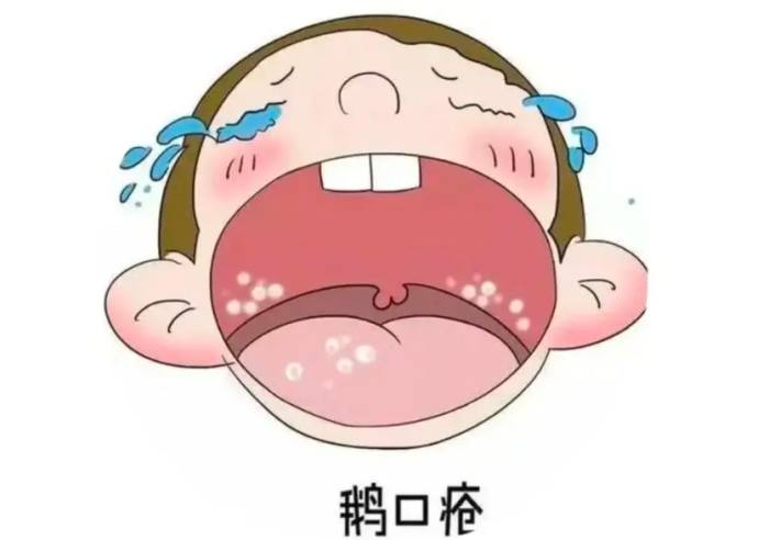 口腔念珠菌感染症狀 口腔念珠菌感染症狀