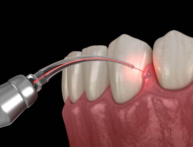 激光牙齦治療風險