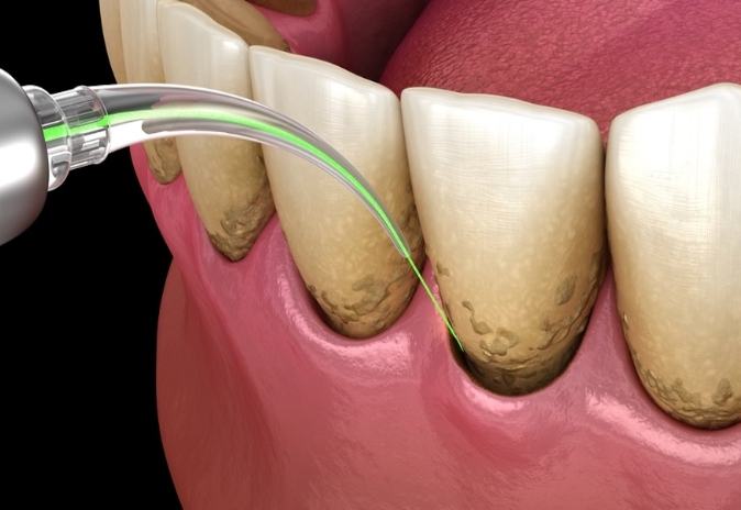 牙齦雷射副作用
