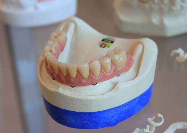 牙齦雷射副作用