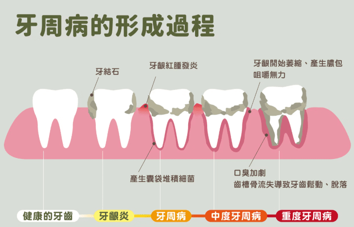 牙齦流血原因