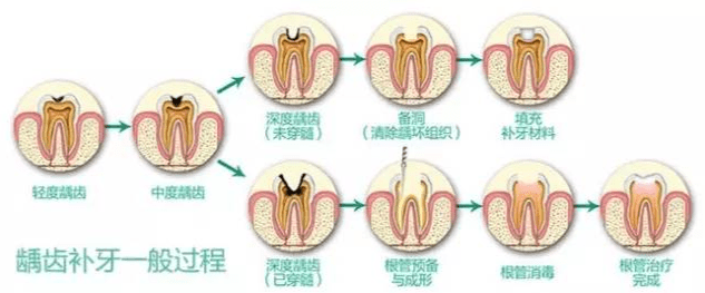 蛀牙治療