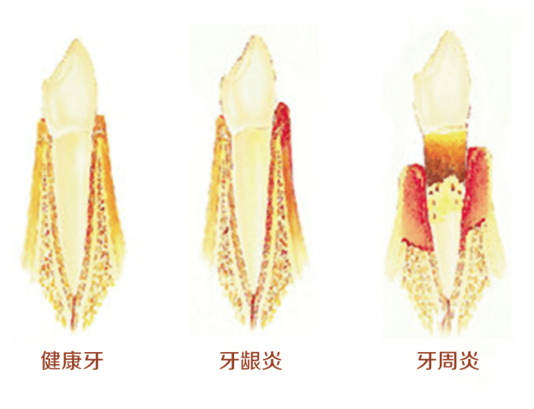 牙周病治療