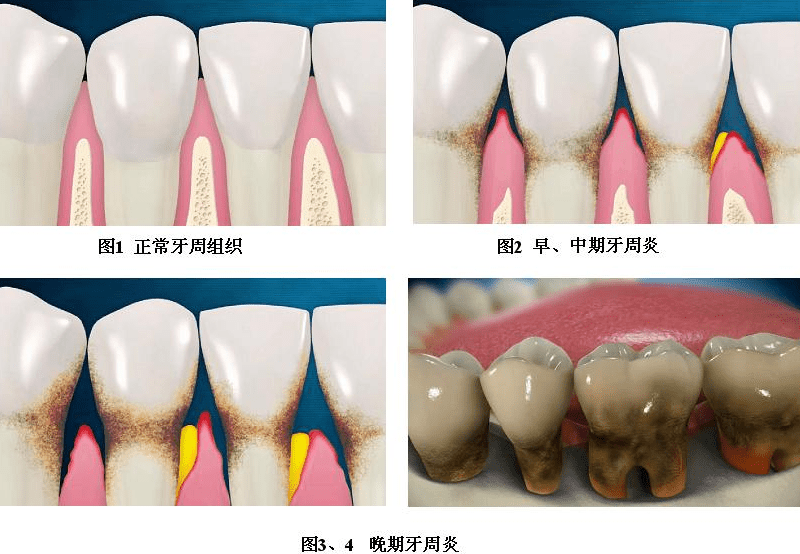 牙周病治療費用