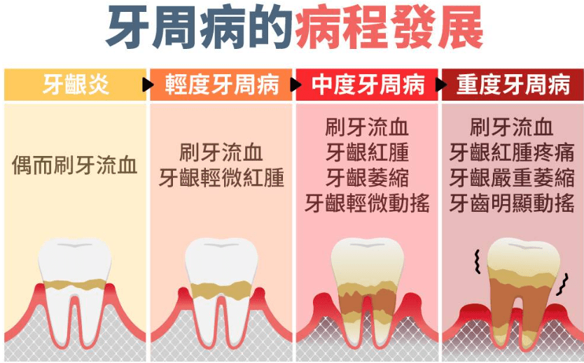 牙周病原因是什麼